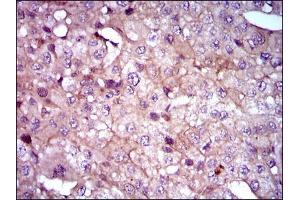 Immunohistochemical analysis of paraffin-embedded liver cancer tissues using SHH mouse mAb with DAB staining.