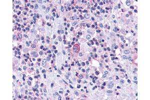 Anti-CCR7 antibody IHC of human Bone, Eosinophilic Granuloma.