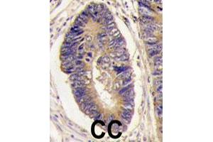 Formalin-fixed and paraffin-embedded human colon carcinoma tissue reacted with PTPN3 polyclonal antibody  , which was peroxidase-conjugated to the secondary antibody, followed by DAB staining. (PTPN3 anticorps  (Internal Region))