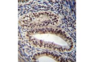 Immunohistochemistry analysis in formalin fixed and paraffin embedded human uterus tissue reacted with PGR Antibody (Center) followed which was peroxidase conjugated to the secondary antibody and followed by DAB staining.