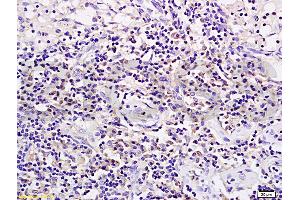 Formalin-fixed and paraffin embedded rat transplant lymphoma labeled with Anti-CD19 Polyclonal Antibody (ABIN724595), Unconjugated 1:200 followed by conjugation to the secondary antibody and DAB staining