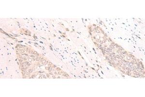Immunohistochemistry of paraffin-embedded Human esophagus cancer tissue using TBC1D2 Polyclonal Antibody at dilution of 1:25(x200) (TBC1D2 anticorps)