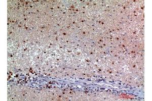 Immunohistochemistry (IHC) analysis of paraffin-embedded Human Kidney Cancer, antibody was diluted at 1:200.