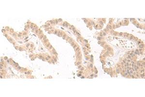 Immunohistochemistry of paraffin-embedded Human thyroid cancer tissue using PBXIP1 Polyclonal Antibody at dilution of 1:40(x200) (PBXIP1 anticorps)