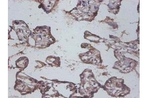 Immunohistochemistry of paraffin-embedded human colon cancer using ABIN7156785 at dilution of 1:100 (IL12B anticorps  (AA 23-328))