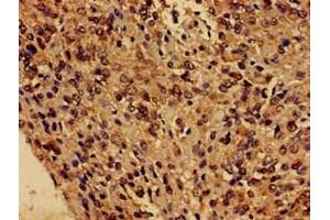 Immunohistochemistry of paraffin-embedded human glioma using ABIN7153243 at dilution of 1:100 (FUNDC1 anticorps  (AA 1-46))