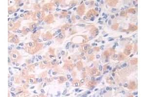 Detection of DSC1 in Human Stomach cancer Tissue using Polyclonal Antibody to Desmocollin 1 (DSC1)