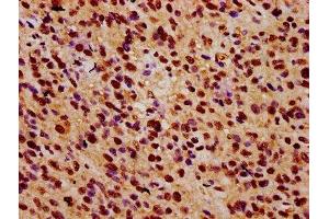 IHC image of ABIN7176167 diluted at 1:500 and staining in paraffin-embedded human glioma performed on a Leica BondTM system.