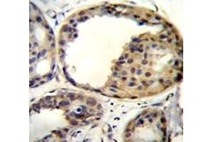 AKT1 antibody immunohistochemistry analysis in formalin fixed and paraffin embedded human breast carcinoma