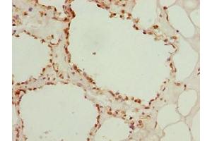 Immunohistochemistry of paraffin-embedded human breast cancer using ABIN7153448 at dilution of 1:100 (LGALS12 anticorps  (AA 1-336))