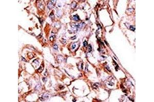 IHC analysis of FFPE human hepatocarcinoma tissue stained with the phospho-HER4 antibody. (ERBB4 anticorps  (pTyr1188))