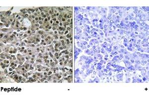 Immunohistochemical analysis of paraffin-embedded human breast carcinoma tissue using NFATC4 polyclonal antibody . (NFATC4 anticorps)