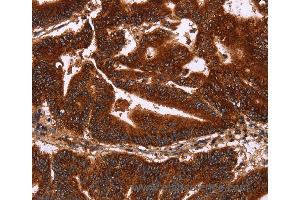 Immunohistochemistry of Human gastric cancer using GCKR Polyclonal Antibody at dilution of 1:50 (GCKR anticorps)