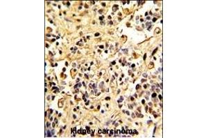 Formalin-fixed and paraffin-embedded human kidney carcinoma with Neprilysin Antibody (C-term), which was peroxidase-conjugated to the secondary antibody, followed by DAB staining.