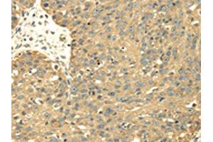 The image on the left is immunohistochemistry of paraffin-embedded Human breast cancer tissue using ABIN7128021(SRPRB Antibody) at dilution 1/30, on the right is treated with fusion protein. (SRPRB anticorps)