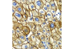 Immunohistochemistry of paraffin-embedded human liver injury using ASGR1 antibody. (Asialoglycoprotein Receptor 1 anticorps)