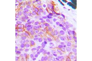 Immunohistochemical analysis of BIM staining in human breast cancer formalin fixed paraffin embedded tissue section.