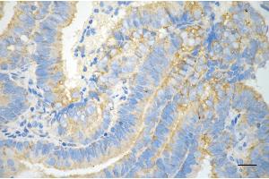 Immunohistochemistry was performed on paraffin-embedded human endometrial carcinoma using NF-kB p65 antibody (ABIN7799645), 1:200). (Recombinant NF-kB p65 anticorps)