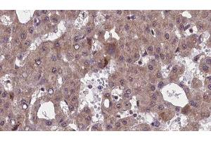ABIN6277548 at 1/100 staining Human liver cancer tissue by IHC-P. (CHRM5 anticorps  (C-Term))