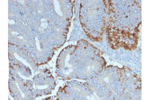 Formalin-fixed, paraffin-embedded human Colon Carcinoma stained with ATG5 Mouse Monoclonal Antibody (ATG5/2492). (ATG5 anticorps  (AA 1-119))