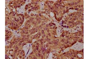 IHC image of ABIN7168937 diluted at 1:400 and staining in paraffin-embedded human liver cancer performed on a Leica BondTM system.