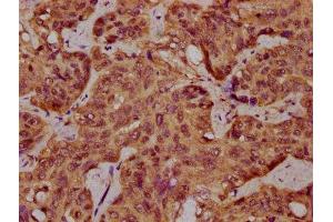 IHC image of ABIN7168937 diluted at 1:400 and staining in paraffin-embedded human liver cancer performed on a Leica BondTM system. (SPINK9 anticorps  (AA 20-86))