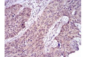 Immunohistochemical analysis of paraffin-embedded cervical cancer tissues using CASP-7 mouse mAb with DAB staining.