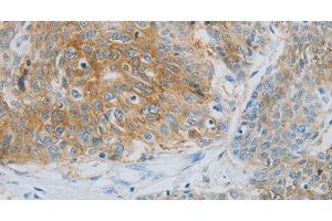 Immunohistochemistry of paraffin-embedded Human esophagus cancer using NDRG1 Polyclonal Antibody at dilution of 1:70 (NDRG1 anticorps)