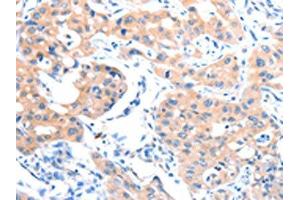 The image on the left is immunohistochemistry of paraffin-embedded Human lung cancer tissue using ABIN7128186(ACSM5 Antibody) at dilution 1/35, on the right is treated with fusion protein. (ACSM5 anticorps)