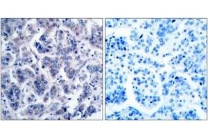 Immunohistochemistry analysis of paraffin-embedded human breast carcinoma tissue, using TYK2 (Ab-1054) Antibody. (TYK2 anticorps  (AA 1020-1069))