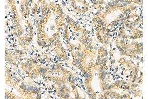 ABIN6258794 and ABIN6275896 at 1/100 staining Human colorectal cancer by IHC-P. (FAM3D anticorps  (C-Term))