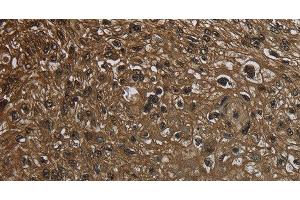 Immunohistochemistry of paraffin-embedded Human esophagus cancer using GLO1 Polyclonal Antibody at dilution of 1:50