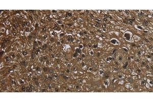 Immunohistochemistry of paraffin-embedded Human esophagus cancer using GLO1 Polyclonal Antibody at dilution of 1:50 (GLO1 anticorps)