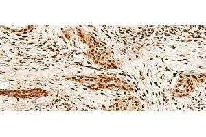 Immunohistochemistry of paraffin-embedded Human esophagus cancer tissue using PAFAH1B2 Polyclonal Antibody at dilution of 1:60(x200) (PAFAH1B2 anticorps)
