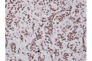 IHC-P Image Immunohistochemical analysis of paraffin-embedded A549 xenograft , using UAP56, antibody at 1:100 dilution. (DDX39B anticorps)