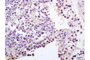 Formalin-fixed and paraffin embedded mouse intestine carcinoma labeled with Anti-CCR5/CD195 Polyclonal Antibody, Unconjugated  at 1:200, followed by conjugation to the secondary antibody and DAB staining