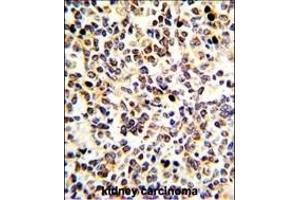 Formalin-fixed and paraffin-embedded human kidney carcinoma with KRT10 Antibody (N-term), which was peroxidase-conjugated to the secondary antibody, followed by DAB staining. (Keratin 10 anticorps  (N-Term))