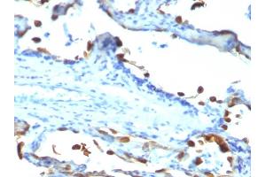 Formalin-fixed, paraffin-embedded human Lung Carcinoma stained with Milk Fat Globule Monoclonal Antibody (EDM45) (MFGE8 anticorps)