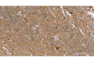Immunohistochemistry of paraffin-embedded Human cervical cancer using PTPN20 Polyclonal Antibody at dilution of 1:30 (PTPN20 anticorps)