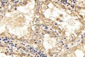 Immunohistochemistry analysis of paraffin-embedded human kidney cancer using TPPP3 (ABIN7076047) at dilution of 1: 3000 (TPPP3 anticorps)