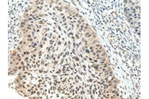 The image on the left is immunohistochemistry of paraffin-embedded Human esophagus cancer tissue using ABIN7191723(NSD1 Antibody) at dilution 1/25, on the right is treated with synthetic peptide. (NSD1 anticorps)