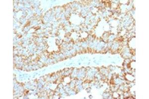 IHC testing of FFPE human colon carcinoma with MAML2 antibody (clone MMLP2-1).