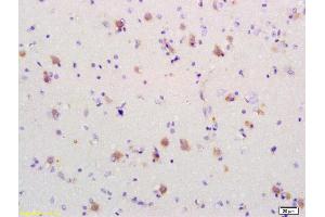 Formalin-fixed and paraffin embedded human brain glioblastoma labeled Anti-PDCD4 Polyclonal Antibody, Unconjugated (ABIN731993) at 1:200, followed by conjugation to the secondary antibody and DAB staining (PDCD4 anticorps  (AA 1-100))