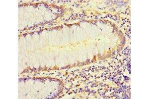 Immunohistochemistry of paraffin-embedded human colon cancer using ABIN7158401 at dilution of 1:100 (L1TD1 anticorps  (AA 665-865))