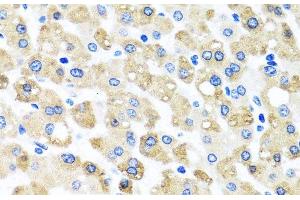 Immunohistochemistry of paraffin-embedded Human liver damage using SNAP29 Polyclonal Antibody at dilution of 1:100 (40x lens). (SNAP29 anticorps)