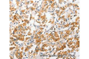 Immunohistochemistry of Human liver cancer using ANAPC2 Polyclonal Antibody at dilution of 1:30 (ANAPC2 anticorps)
