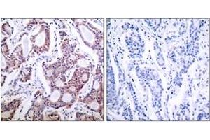 Immunohistochemistry analysis of paraffin-embedded human breast carcinoma tissue, using NF-kappaB p100/p52 (Ab-869) Antibody. (NFKB2 anticorps  (AA 836-885))