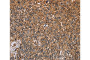 Immunohistochemistry of Human lung cancer using GH2 Polyclonal Antibody at dilution of 1:40 (Growth Hormone 2 anticorps)