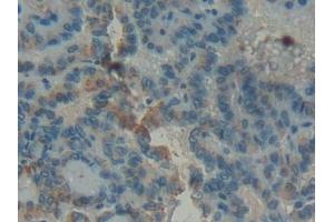 Detection of GBA in Human Thyroid cancer Tissue using Polyclonal Antibody to Glucocerebrosidase (GBA) (GBA anticorps  (AA 117-214))