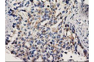 Immunohistochemical staining of paraffin-embedded Carcinoma of Human lung tissue using anti-NDEL1 mouse monoclonal antibody. (NDEL1 anticorps)